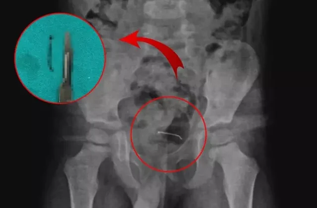 5 yaşındaki çocuğun mesane duvarından çıkan doktorları bile şoke etti