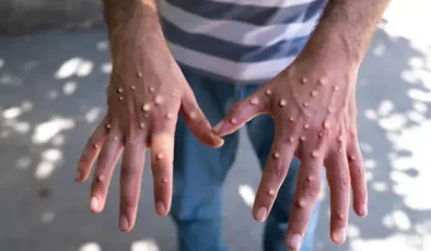Maymun çiçeği alarmı! Ülkede 12 günlük kapanma ilan edildi