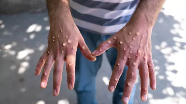 Maymun çiçeği alarmı! Ülkede 12 günlük kapanma ilan edildi