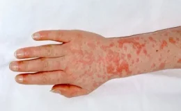 Yunanistan’da Strep-A bakterisi nedeniyle okullar kapatıldı