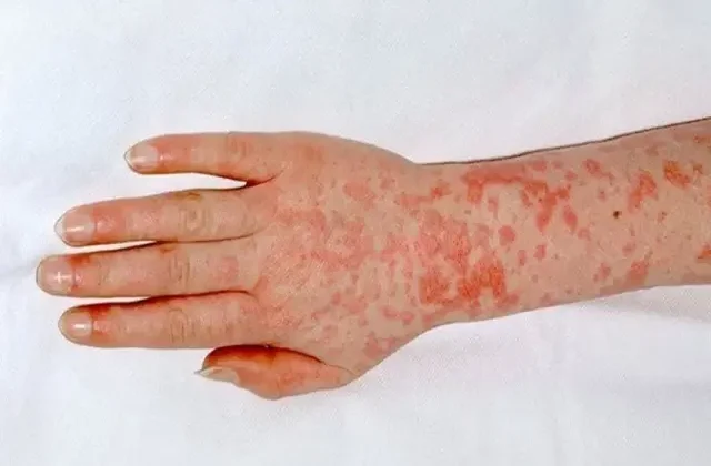 Yunanistan’da Strep-A bakterisi nedeniyle okullar kapatıldı