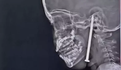Beynine çivi saplanan küçük kız mucizevi şekilde kurtarıldı