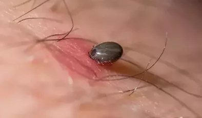Kene ısırığı sonucu Kırım Kongo Kanamalı Ateşi’ne yakalanan adam hayatını kaybetti