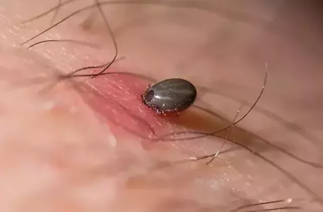Kene ısırığı sonucu Kırım Kongo Kanamalı Ateşi’ne yakalanan adam hayatını kaybetti