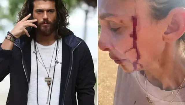 Can Yaman’ın sevgilisi Sara Bluma şiddet gördüğünü açıkladı