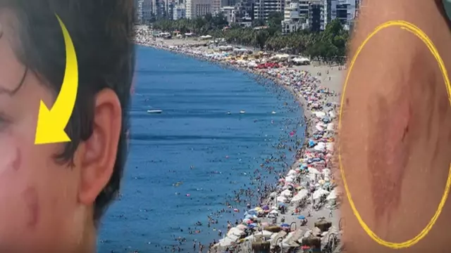 Vatandaşlar tedirgin! Denize giren yanıklarla çıkıyor