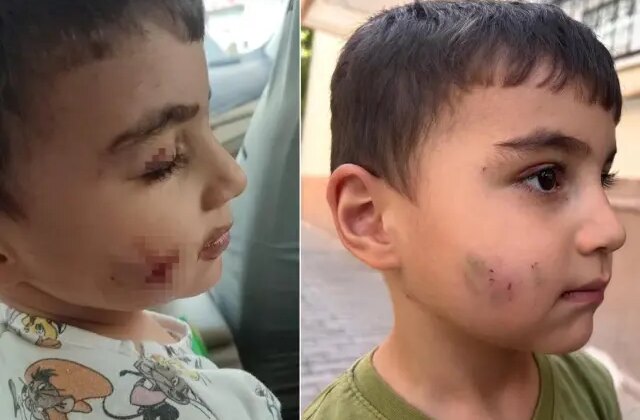 Ankara’nın göbeğinde lağım faresi uyuyan çocuğu ısırdı