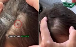 Baba, kızının kafasına yapışan keneyi böyle kopardı