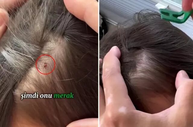 Baba, kızının kafasına yapışan keneyi böyle kopardı