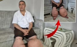 Yüksek ateş şikayetiyle hastaneye gitti, 15 yıldır “fil hastalığı” ile mücadele ediyor