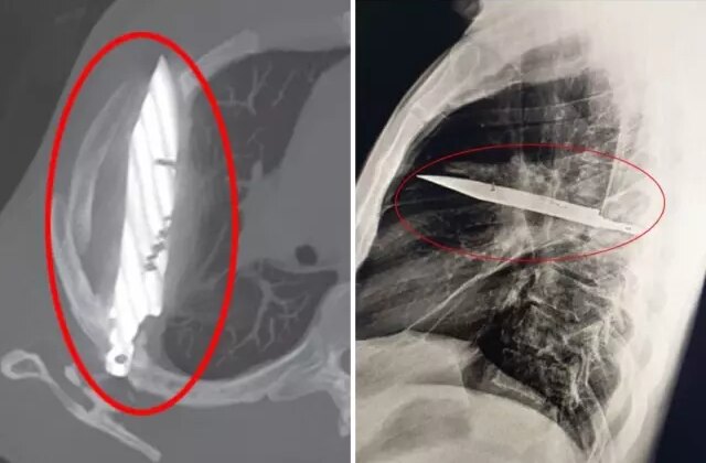 Göğüs ağrısıyla hastaneye gitti, göğsünde 8 yıldır bıçakla yaşadığı ortaya çıktı!