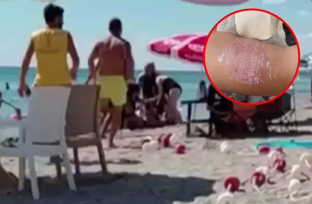 Plaj keyfi ‘sigara dumanı’ ile kabusa döndü, üst üste dövüşüp kolunu ısırdı