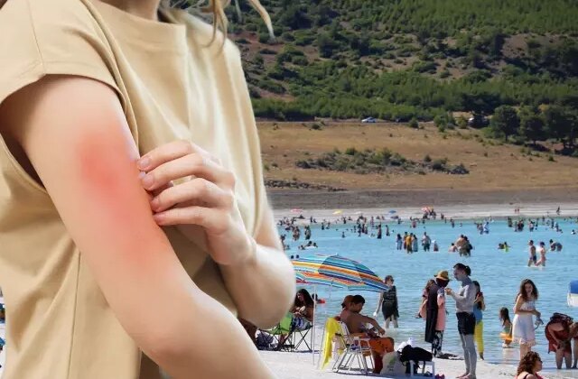 Et yiyen bakteri vakası Türkiye’de görüldü mü? Bakanlıktan açıklama