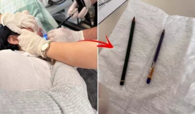 Genç kadının midesinden iki adet kalem çıkarıldı