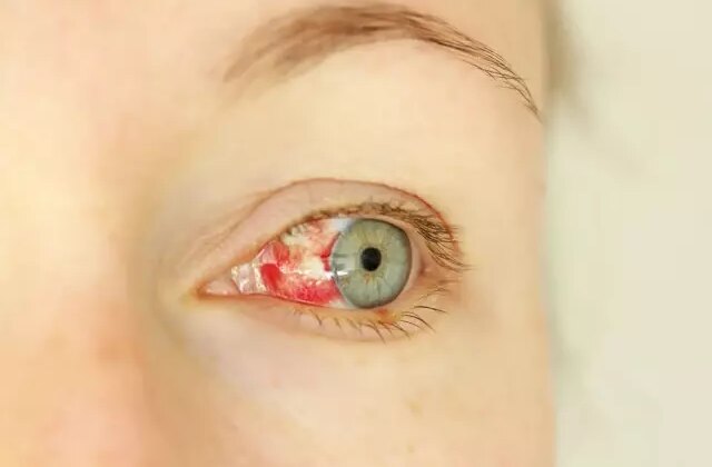 Gözde kanama ile başlayan gizemli salgın yayılıyor: 8 ölü