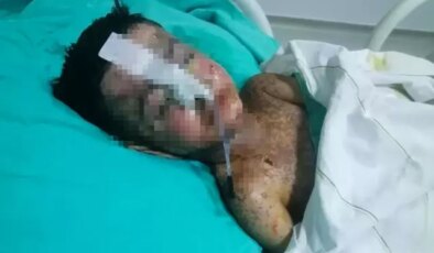 Salatalık yutunca öksürmeye başlayan çocuğun vücudunda kateter unutulduğu ortaya çıktı