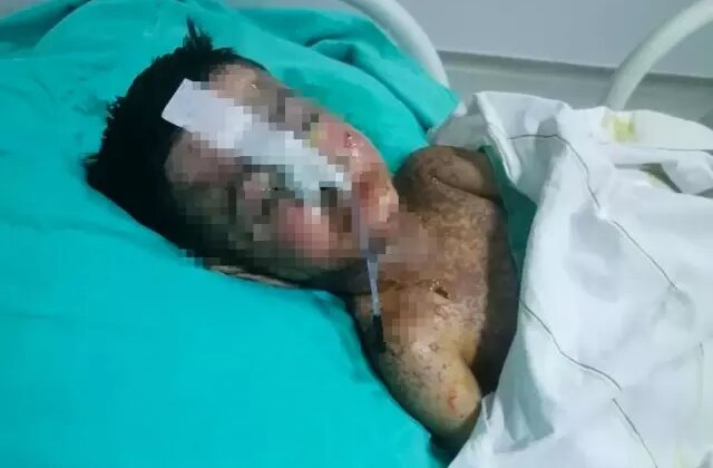 Salatalık yutunca öksürmeye başlayan çocuğun vücudunda kateter unutulduğu ortaya çıktı