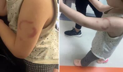 Özel kreşte vahim iddia: Öğretmen, 3 yaşındaki çocuğun kolunu ısırdı