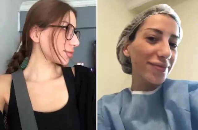 Devlet hastanesinde burun ameliyatı oldu! İşte genç kadının yaşadığı değişim