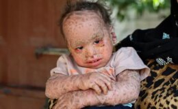 Balık pulu ve kelebek hastası Yusuf’un fotoğraflarını çalıp dolandırıcılık yaptılar