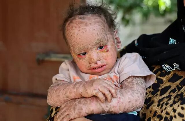 Balık pulu ve kelebek hastası Yusuf’un fotoğraflarını çalıp dolandırıcılık yaptılar