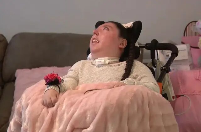 Beyinsiz doğan Alex 20 yaşında, doktorlar 5 yıl yaşamaz demişti