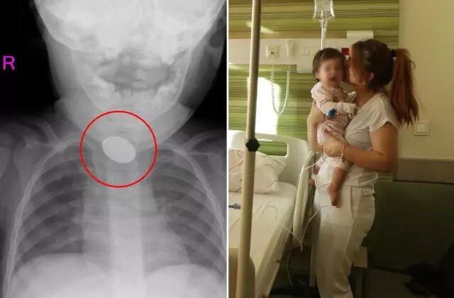 Kardeşi fark etti, hastaneye koştular! 15 aylık bebeğin yemek borusundan çıkanlar şoke etti