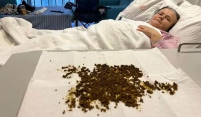 Karın ağrısı şikayetiyle gitti, safra kesesinden 20 bin taş çıkarıldı