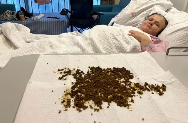 Karın ağrısı şikayetiyle gitti, safra kesesinden 20 bin taş çıkarıldı