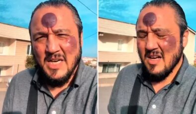 Yüzüne yaptırdığı işlemden sonra bu hale geldi, yine de savundu