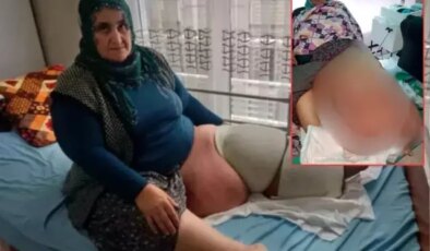 35 yıldır aynı hastalıkla mücadele ediyor! Bacağının ağırlığı 100 kiloya kadar çıktı