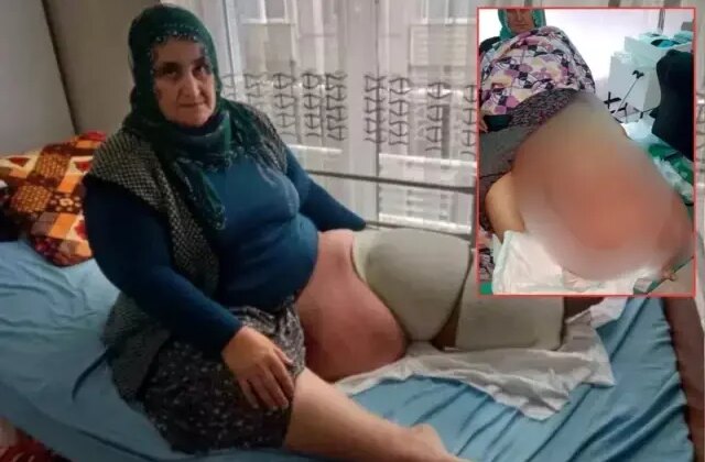 35 yıldır aynı hastalıkla mücadele ediyor! Bacağının ağırlığı 100 kiloya kadar çıktı