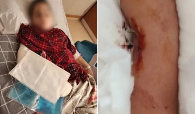 9 yaşındaki çocuk, 8 yaşındaki çocuğun kolunu kırarak intikam aldı