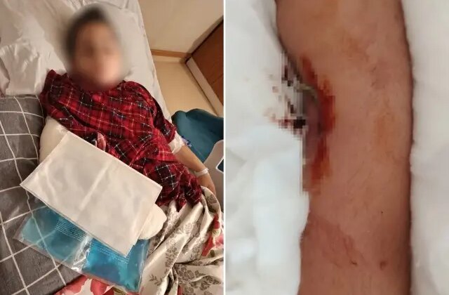 9 yaşındaki çocuk, 8 yaşındaki çocuğun kolunu kırarak intikam aldı