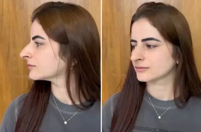 Hevesle burun estetiği oldu ama sonu skandal