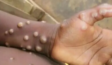 Madagaskar’da ilk defa M çiçeği vakası tespit edildi