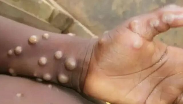 Madagaskar’da ilk defa M çiçeği vakası tespit edildi