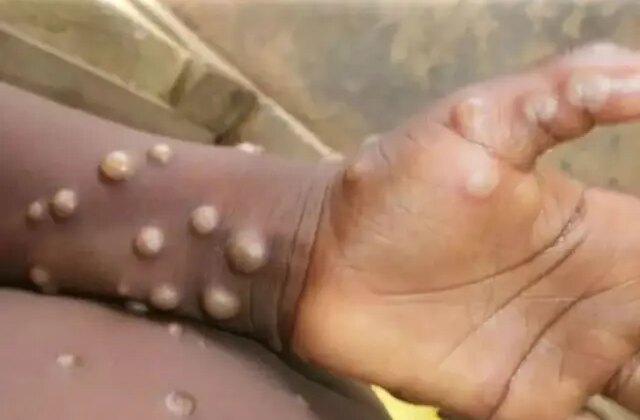 Madagaskar’da ilk defa M çiçeği vakası tespit edildi