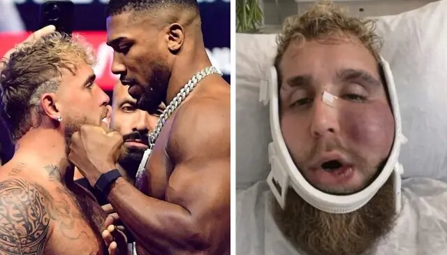 Suratı tanınmaz hale gelen Jake Paul’un ne kadar kazandığını duyunca şok olacaksınız