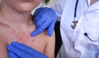 Vakalar son 30 yılda pik yaptı! İki haftada ortaya çıkıyor, 3 yıl kadar sürüyor