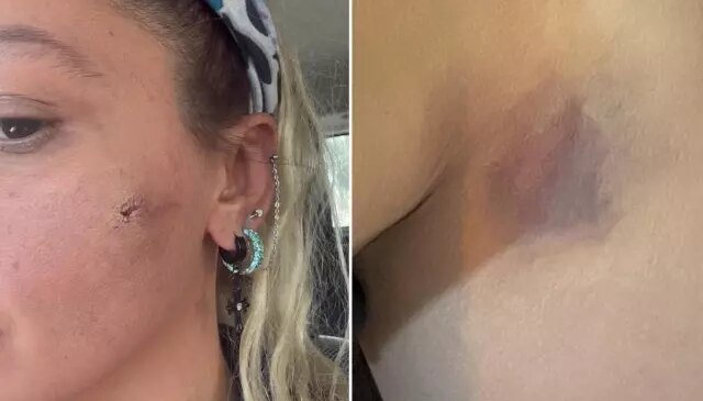 Yıldız Asyalı kocasından şiddet gördüğünü açıkladı