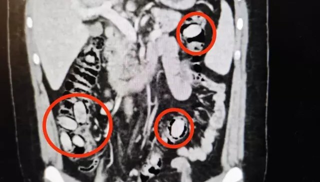 Eskişehir’de polisin durdurduğu şahsın midesinden çıkanlar şoke etti