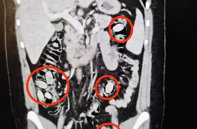 Eskişehir’de polisin durdurduğu şahsın midesinden çıkanlar şoke etti