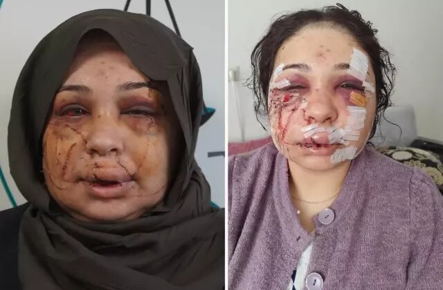 Polis eşi tarafından darbedildiği iddiasıyla şikayetçi oldu