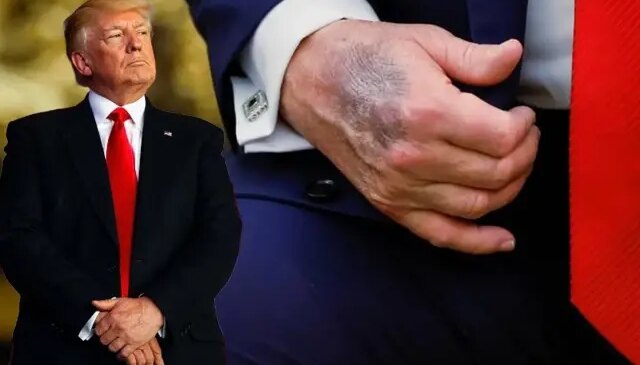 Trump elindeki morluğun nedeni açıkladı