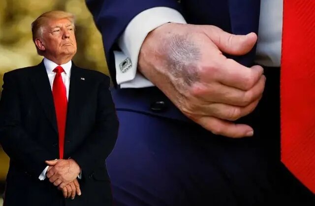 Trump elindeki morluğun nedeni açıkladı