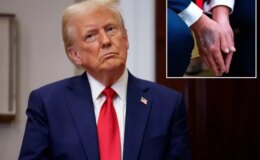 Trump elindeki morlukların nedenini ilk kez açıkladı