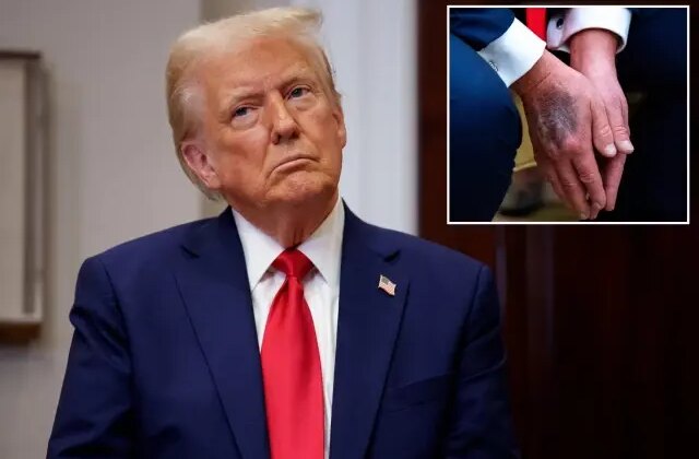 Trump elindeki morlukların nedenini ilk kez açıkladı