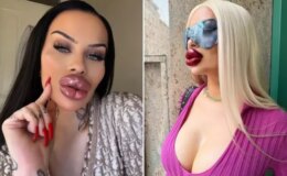 Estetiğe 60 bin dolar harcayan fenomen: Artık ağzımı kapatamıyorum