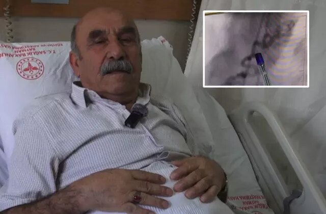 Göğüs yanması şikayetiyle gittiği hastanede kalbinden kan ‘çalan’ damar bulundu